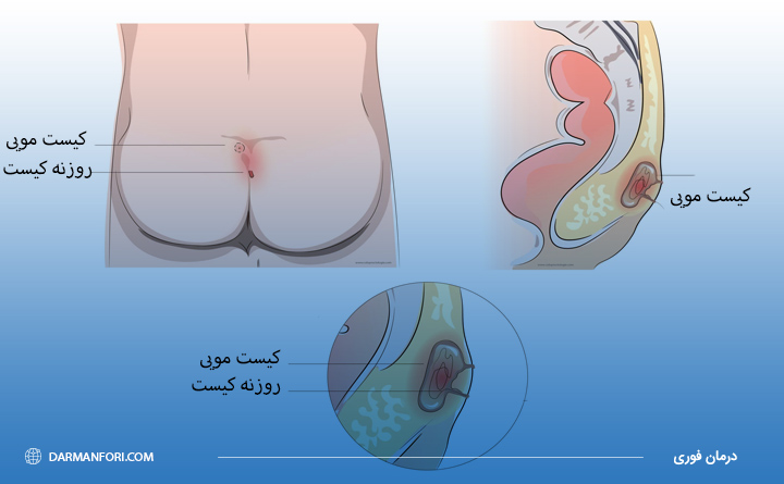 کیست مویی یا سینوس پیلونیدال