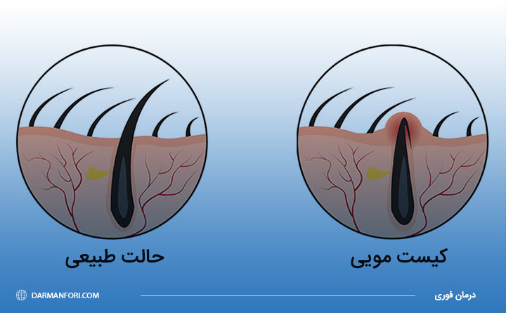 عکس کیست مویی خفیف