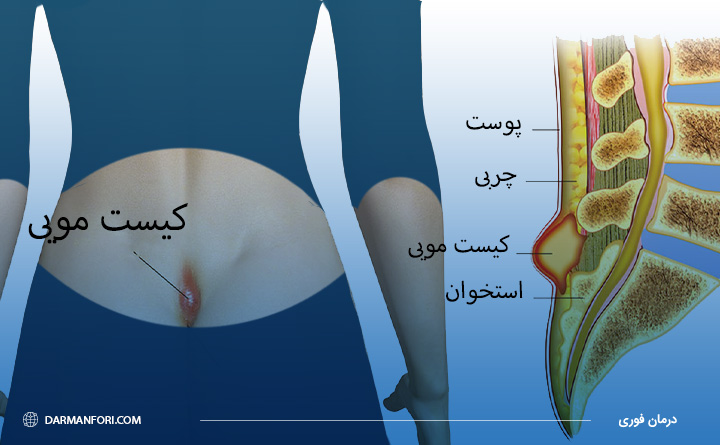 کیست مویی دنبالچه