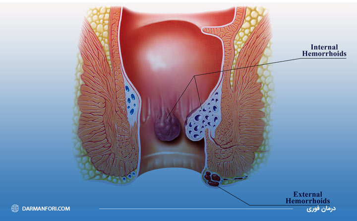 بیماری بواسیر یا هموروئید چیست؟