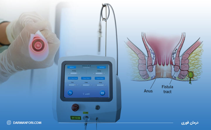 لیزر درمانی فیستول مقعدی در زنان