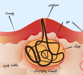 درمان کیست مویی با لیزر