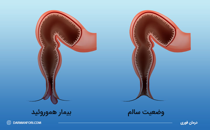 بیماری هموروئید یا بواسیر چیست؟