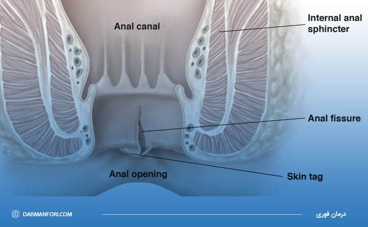 بیماری شقاق یا فیشر مقعدی