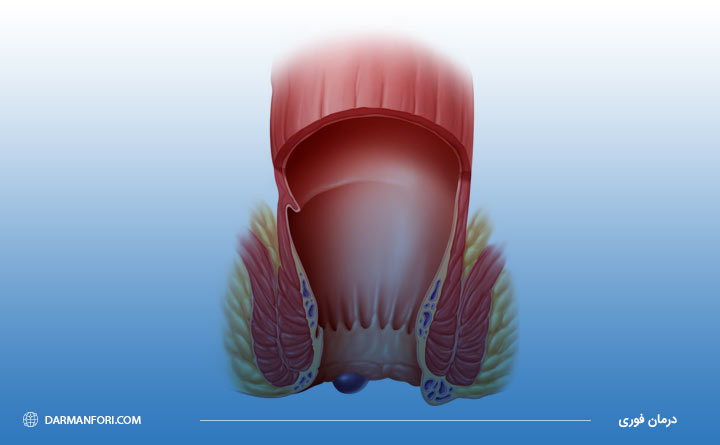 آشنایی با بواسیر یا هموروئید خارجی