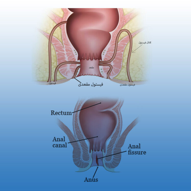 تفاوت شقاق و فیستول برای تشخیص صحیح درمان