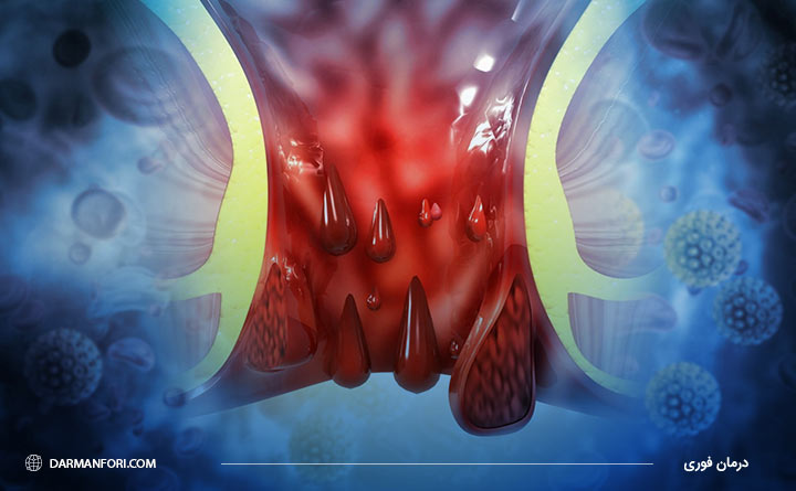 آبسه مقعدی Ischiorectal