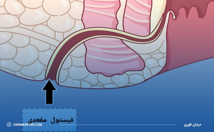 فیستول مقعدی