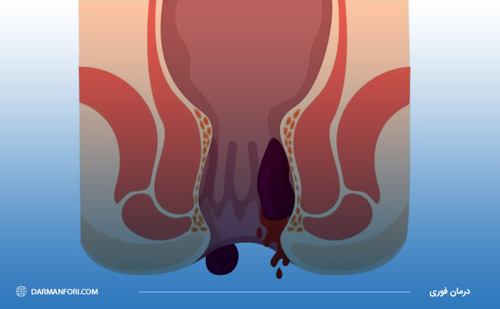 عوارض خون ریزی از مقعد 