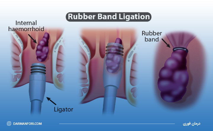 درمان بواسیر با استفاده از رابربند