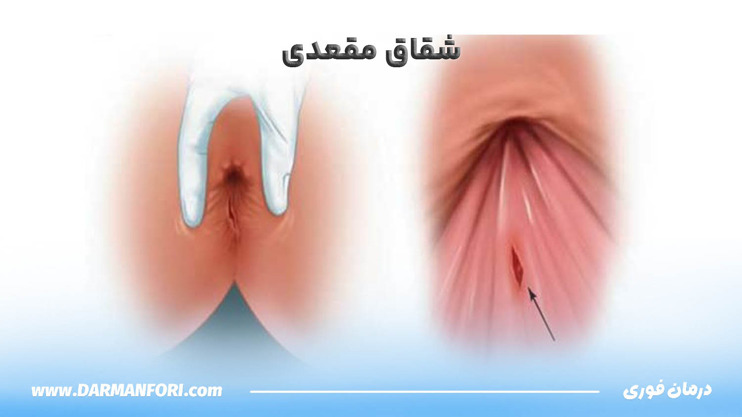تصویر شقاق مقعدی و ترک پوستی اطراف مقعد که باعث سوزش و درد هنگام دفع میشود