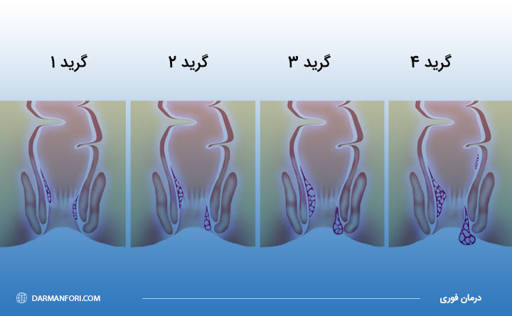 انواع بواسیر یا هموروئید