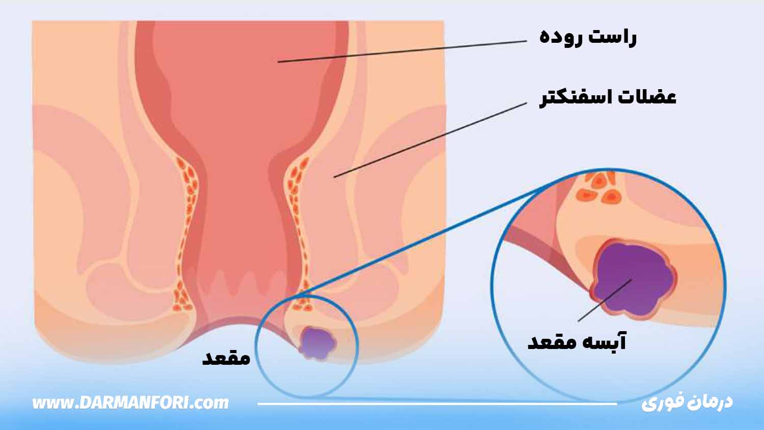 تصویر آبسه مقعدی ؛ تجمع چرک در کنار کانال مقعد و بافت‌های اطراف