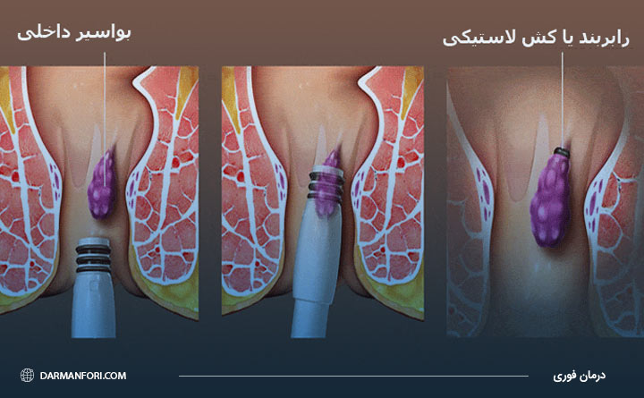 بستن باند لاستیکی برای درمان بواسیر 