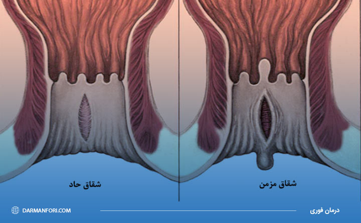 فیشر حاد و مزمن از انواع بیماری شقاق