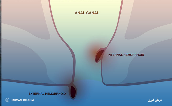 بواسیر داخلی 