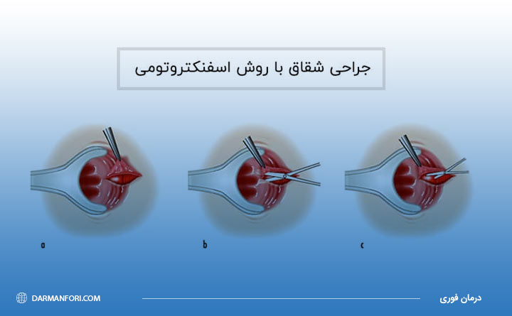 روش اسفنکتروتومی برای جراحی شقاق 