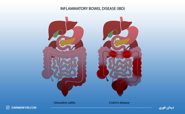 بیماری  التهاب روده یا IBD