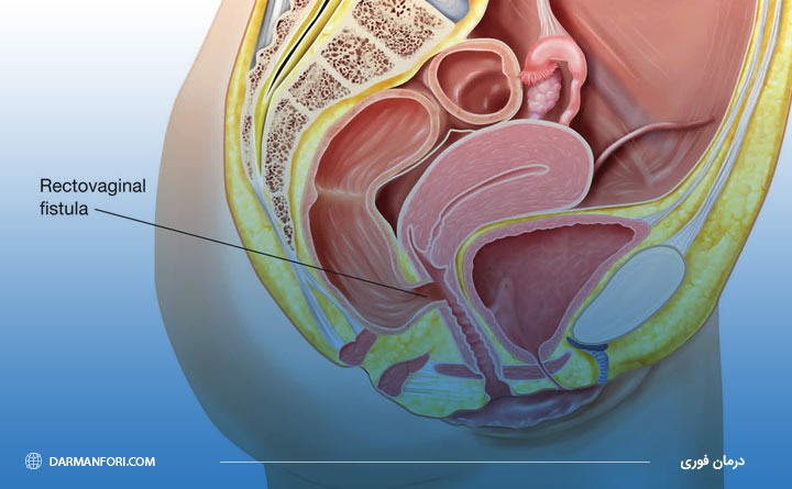 فیستول رکتوواژینال از انواع فیستول در دوران بارداری