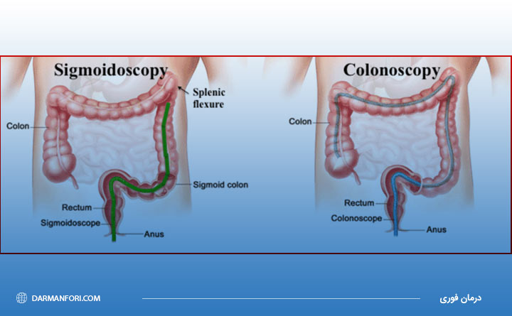تفاوت آزمایش سیگموئیدوسکوپی با کولونوسکوپی