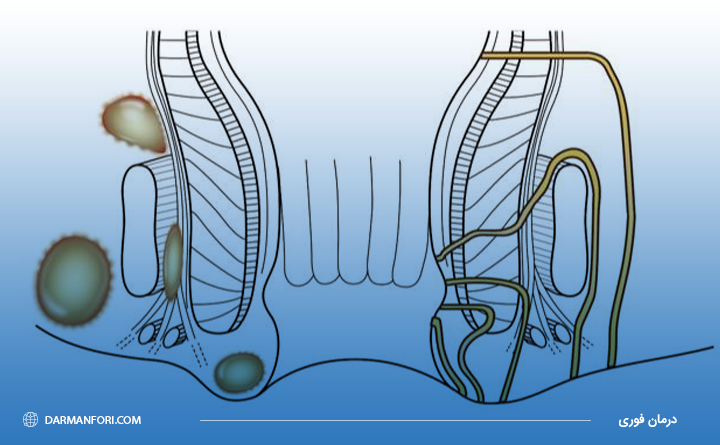 بیماری آبسه مقعدی