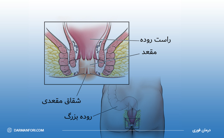 بیماری شقاق یا فیشر