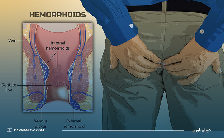 تفاوت بین هموروئید داخلی و خارجی 