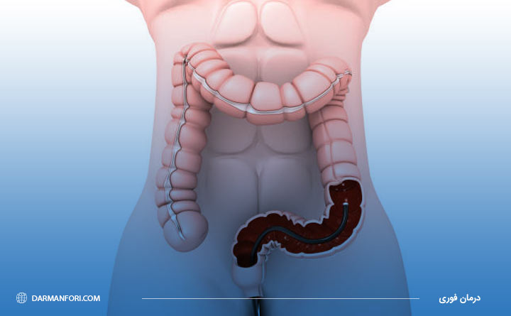 کولونوسکوپی برای تشخیص پولیپ رکتوم