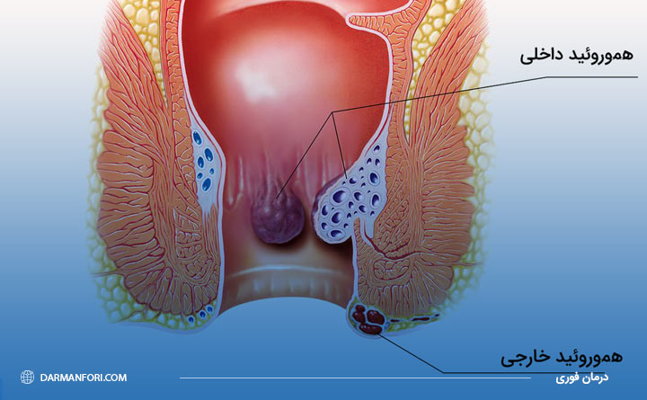 انواع بواسیر یا هموروئید در مردان 
