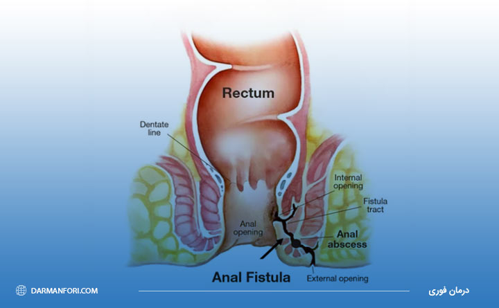 اهمیت درمان بیماری فیستول توسط متخصص