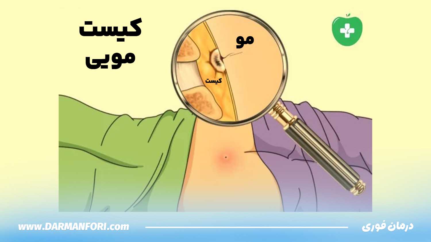 علائم کیست مویی مزمن
