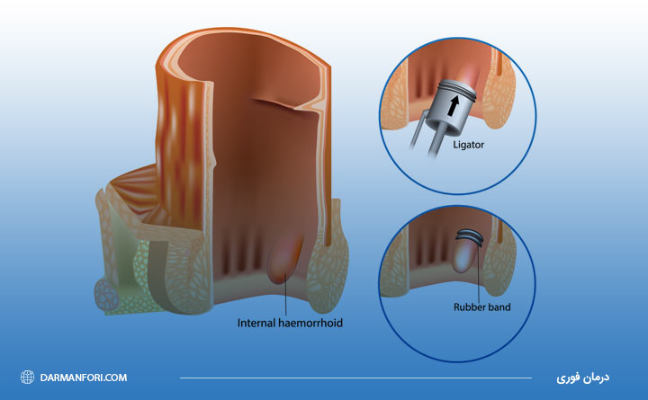 رابربند برای جراحی بواسیر