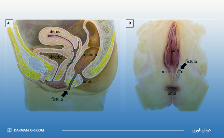 فیستول واژن تناسلی - ادراری 