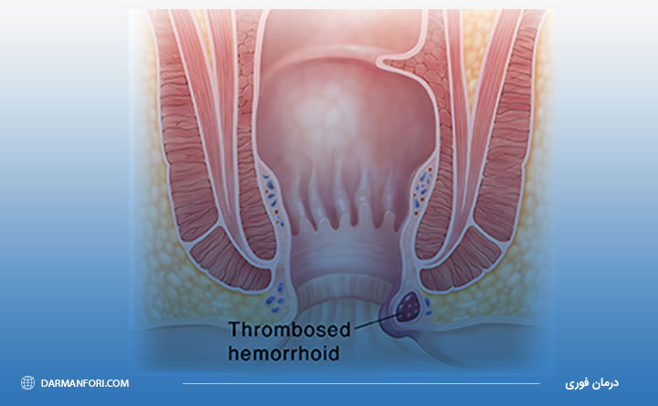 بواسیر خونی (همورئید) ترومبوز