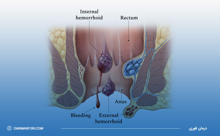 آشنایی با بواسیر خونی
