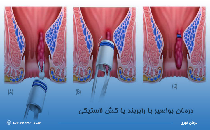 درمان بواسیر یا هموروئید با رابربند 