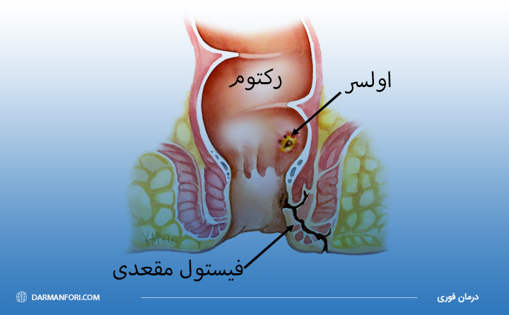 فیستول مقعدی چیست؟