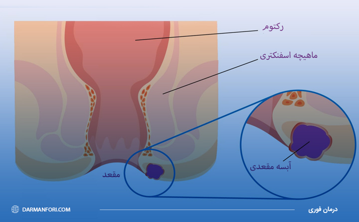 بیماری آبسه مقعد