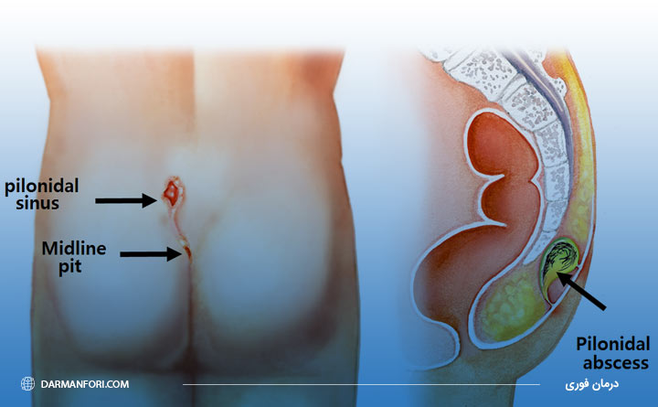 آشنایی با تفاوت کیست مویی و آبسه مقعد