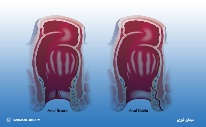 فیستول مقعدی علت احساس درد در مقعد