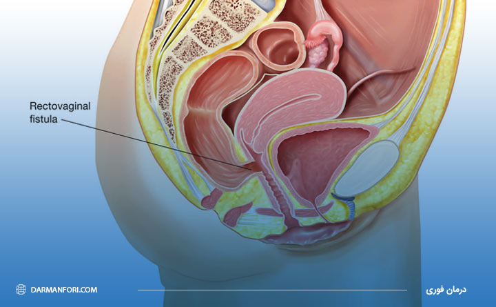 آشنایی با بیماری فیستول در زنان