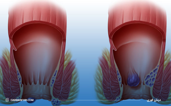 بیماری هموروئید