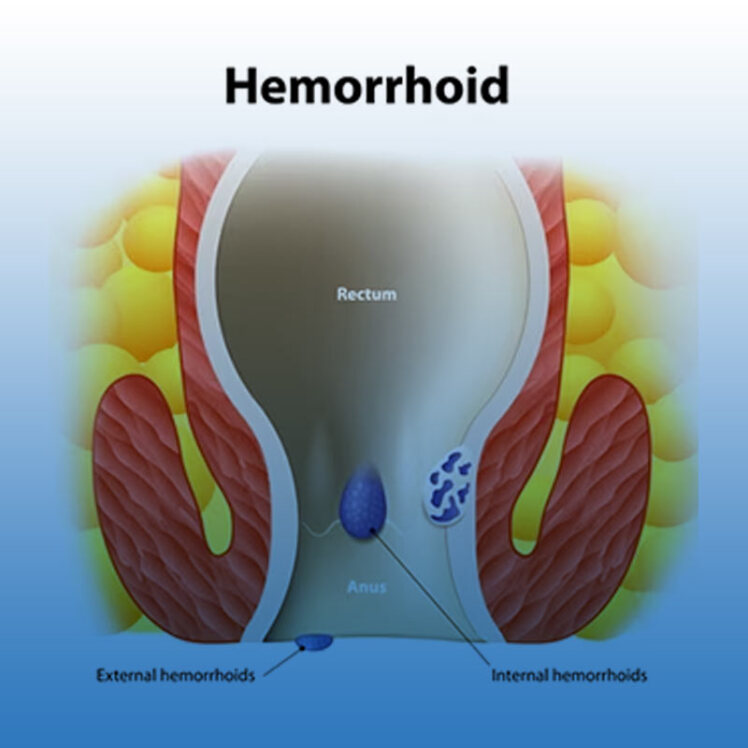 عوارض درمان نکردن بواسیر یا هموروئید را بشناسید