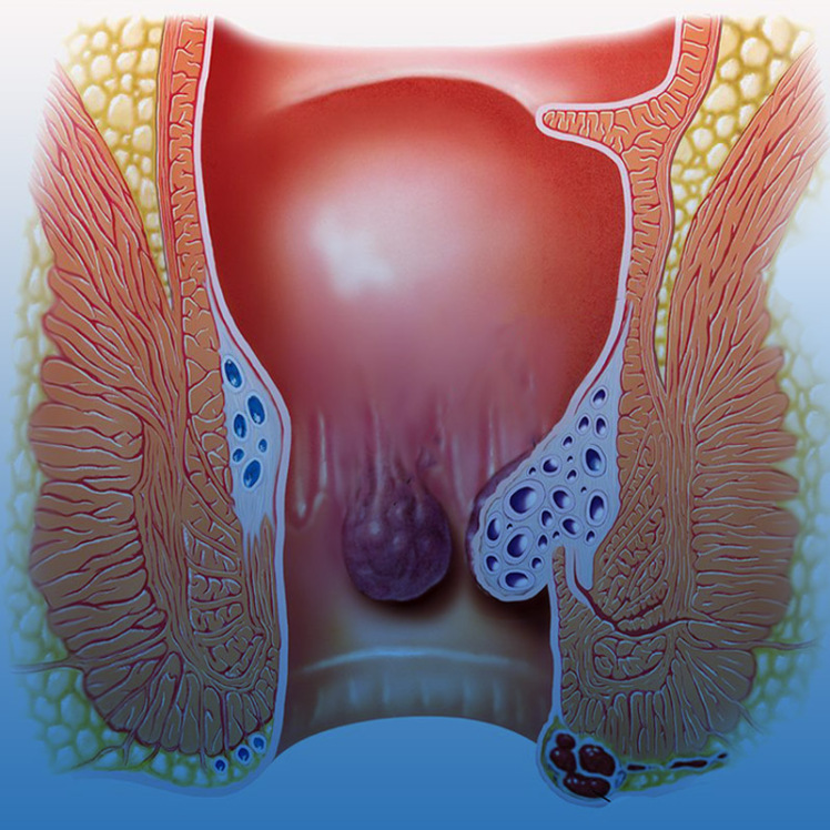 بواسیر یا هموروئید چیست؟ علل، علائم + تشخیص بواسیر