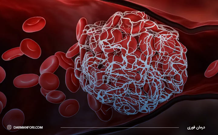 لخته‌شدن خون از عوارض درمان شقاق با دیلاتاسیون