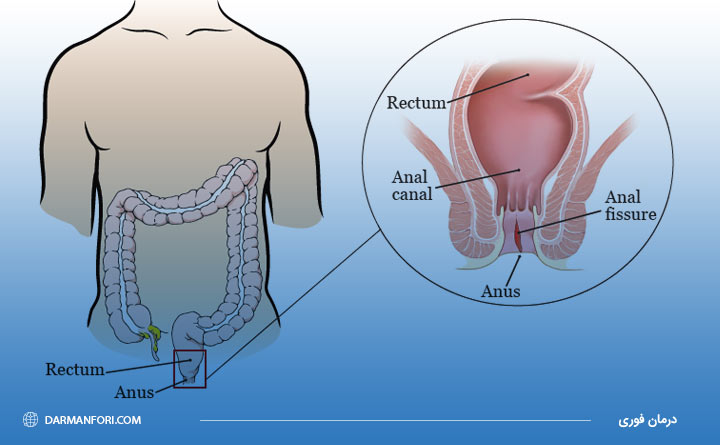 آشنایی با شقاق مقعدی