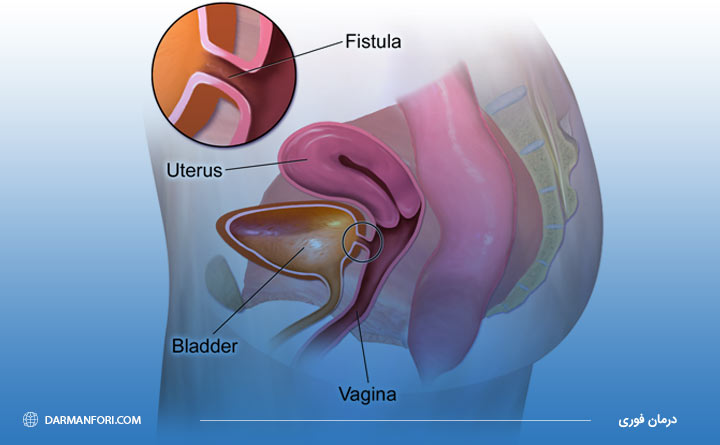 مشکل فیستول در دوران بارداری 