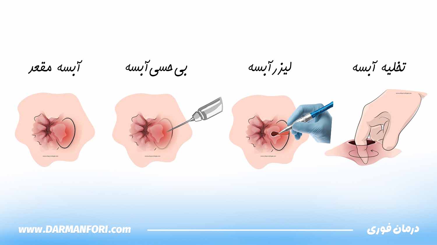 تخلیه آبسه مقعدی با برش کوچک بوسیله لیزر و بی‌حسی موضعی در کلینیک