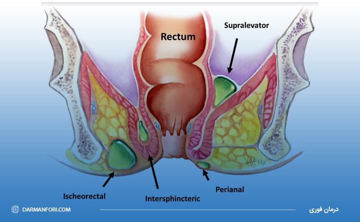 آبسه مقعدی و بوی بد مقعد