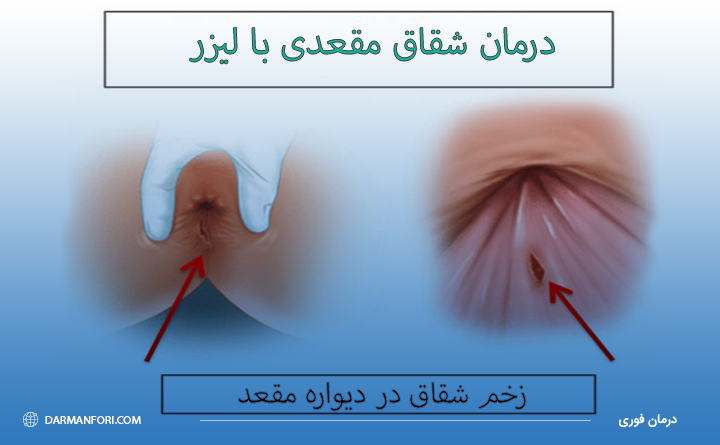 لیزر شقاق مقعدی 